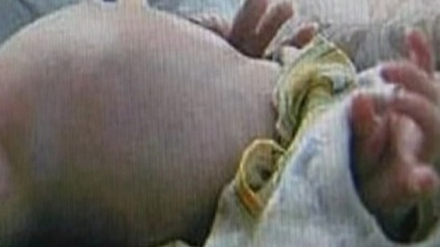 il bambino da due anni viveva con il fratello parassita nella pancia