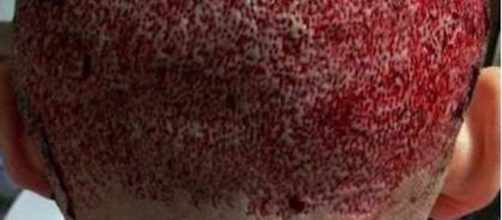 &Aacute;rea doadora ap&oacute;s transplante capilar em cl&iacute;nica clandestina