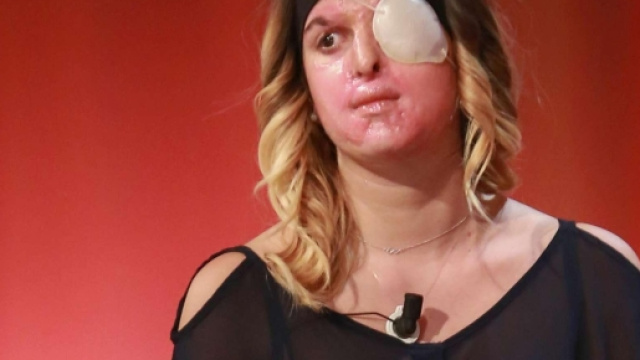 Gessica Notaro si &egrave; mostrata in questi lunghi mesi con il viso deturpato e la benda su un occhio