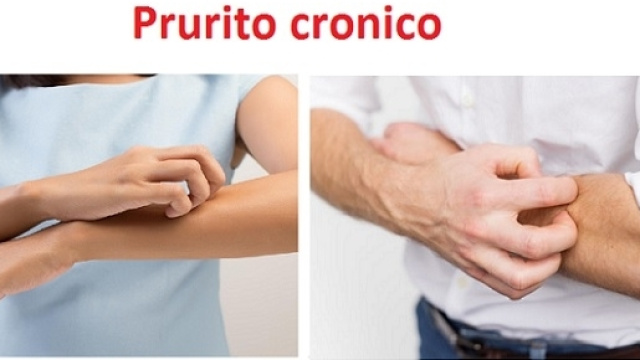 Serlopitant, il primo farmaco sperimentale per il prurito cronico, disturbo finora trattato solo con antistaminici e corticosteroidi.