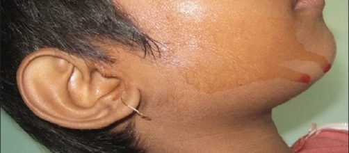 Hematohidrosis | By Saugato Biswas, Trupti Surana, Abhishek De (Image via Falguni Nag/Wikimedia Commons)