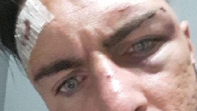 Giuliano Fildigrano mostra i segni dell'aggressione subita a Novara