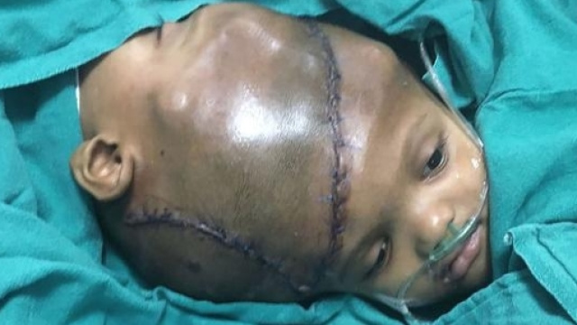 Gemelli siamesi separati dopo 27 ore di intervento (immagine di repertorio)