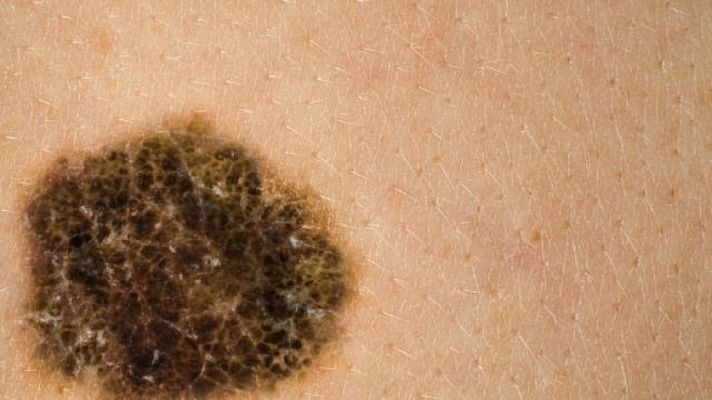 Il melanoma &egrave; il terzo tumore pi&ugrave; diffuso sotto i 50 anni