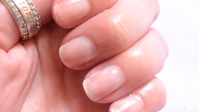Manicure da dimenticare per Ardiana: dito dilaniato