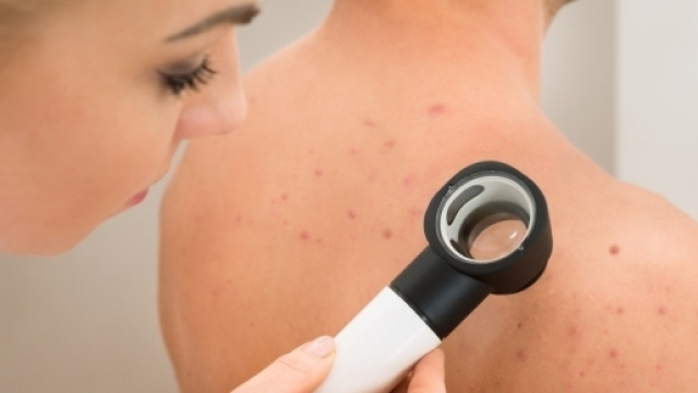 Melanoma: una nuova scoperta per la sua cura