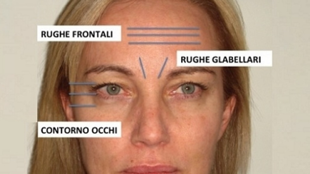 Le rughe sul viso non sono tutte uguali. Oggi la medicina estetica ha a disposizione diversi prodotti e tecniche di intervento.