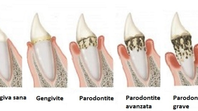 La parodontite &egrave; una patologia a carico di gengive e denti con effetti su altre patologie. &Egrave; importante identificare i batteri responsabili.
