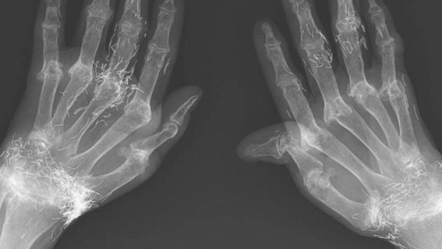 Corea del Sud, forti dolori alle mani: oro nella carne