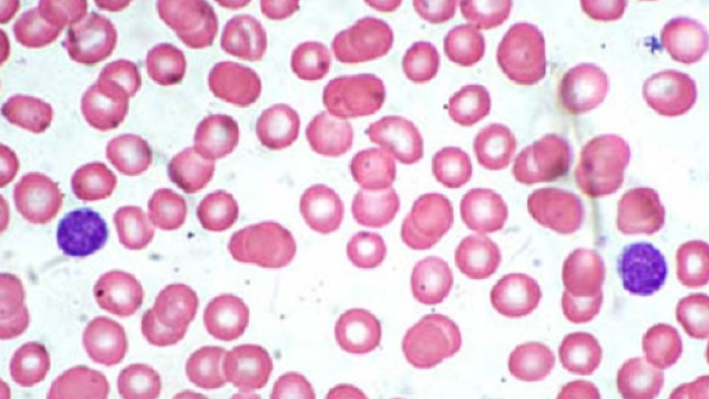 Il linfoma mantellare &egrave; una rara forma di linfoma non Hodgkin: adesso ha una nuova terapia (acalabrutinib), risolutiva nel 40% dei casi.