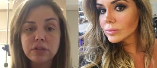 Renata Banhara contraiu bact&eacute;ria que fez com que apodrecesse a pele de seu rosto