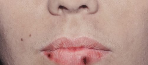 Conhe&ccedil;a mais sobre esse tipo de doen&ccedil;a.