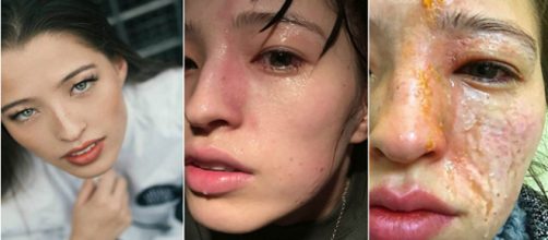 Jovem fica com queimaduras graves no rosto (Fotos: Reprodu&ccedil;&atilde;o/Redes sociais)