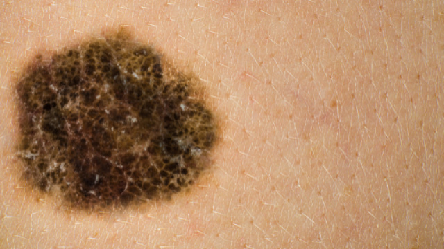 Melanoma, studi recenti - melanomanewstoday.com