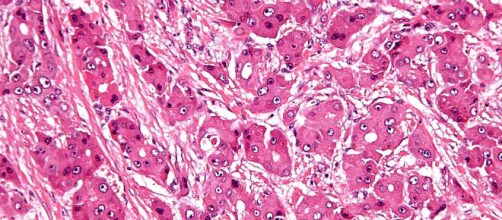 High magnification micrograph of FL-HCC. - [Image via Nephron / Wikimedia Commons]