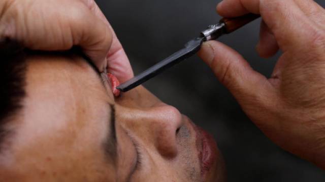 Un paziente di Xiong che si sottopone al trattamento