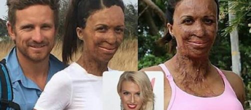 Turia Pitt, a mulher guerreira que venceu todas as batalhas