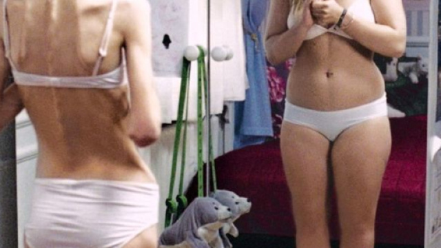 Il problema dell'anoressia sempre pi&ugrave; diffuso tra le giovani