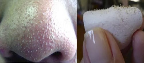 Quer saber como se livrar de cravos e espinhas? Confira!