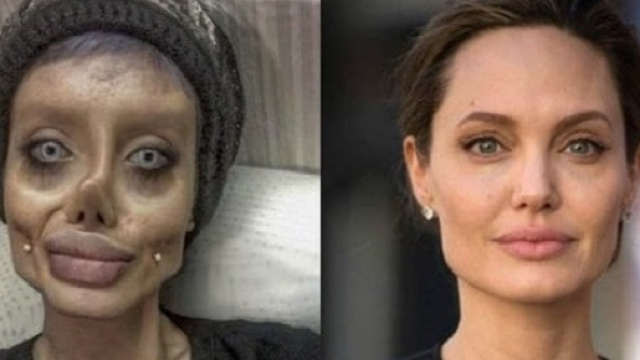 La ragazza che si &egrave; sottoposta a 50 operazioni chirurgiche per somigliare alla Jolie.