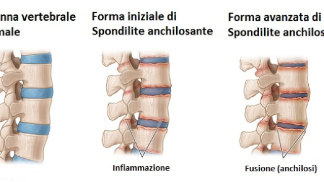 Secukinumab, l&rsquo;anti-IL-17A, l&rsquo;inibitore selettivo della citochina pro-infiamamtoria, &egrave; in grado di bloccare la progressione della malattia.