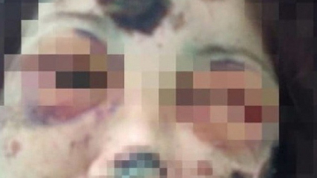 Il volto della donna &egrave; stato pesantemente sfigurato