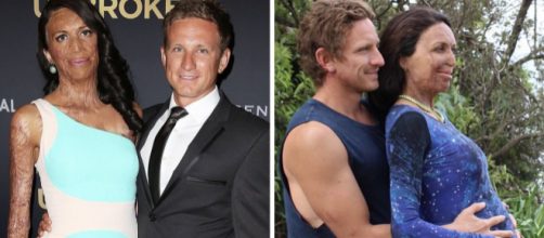 Turia Pitt posa ao lado de seu esposo, Michael Hoskin, que deu grande apoio &agrave; ex-modelo.