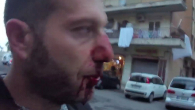 Daniele Piervincenzi, frattura al naso dopo l'aggressione di Roberto Spada