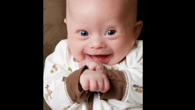 Bambino affetto da sindrome di Down. Credit: newswall.com