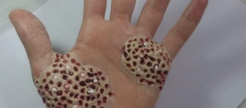 Entenda mais sobre o transtorno da tripofobia. (Foto Reprodu&ccedil;&atilde;o)