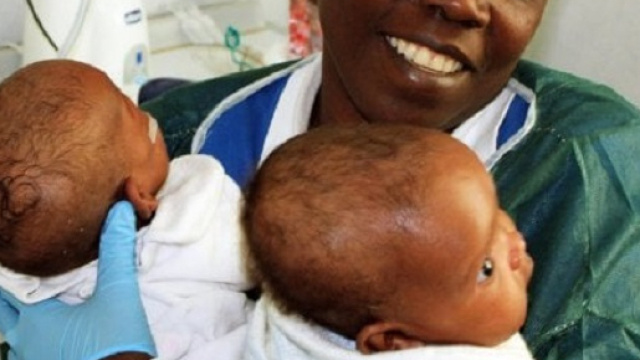 Eccezionale intervento al Bambino Ges&ugrave; di Roma, separate due gemelline siamesi del Burundi