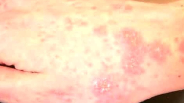 alcune macchie di scabbia alla mano