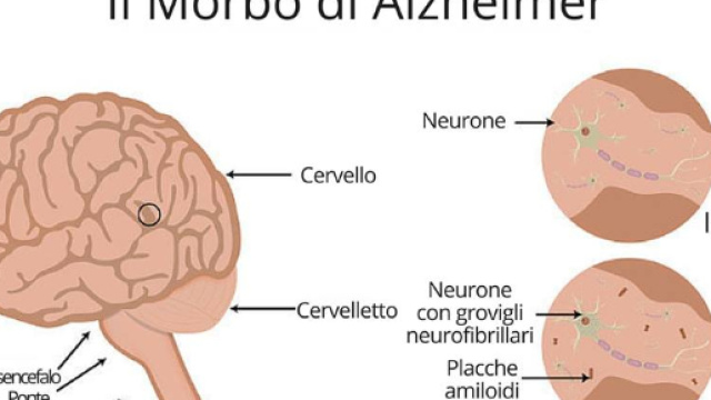 Alzheimer, neuroinfiammazione e placche amiloidi