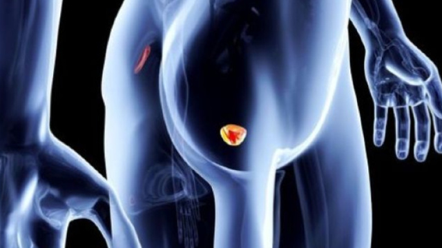 La Societ&agrave; italiana di urologia ha lanciato un appello per minimizzare le conseguenze del tumore alla prostata.