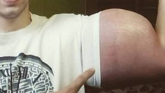 Vuole diventare Popeye ma rischia l'amputazione degli arti.