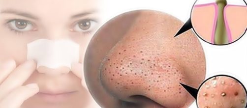 1000 ideias sobre Melasma Tratamento no Pinterest | Tratamento De ... - pinterest.com