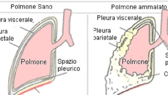 L&rsquo;anticorpo nivolumab riesce a bloccare il mesotelioma nel 50% dei casi.