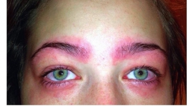 Cette Australienne a failli devenir aveugle &agrave; cause d&rsquo;un produit de beaut&eacute;