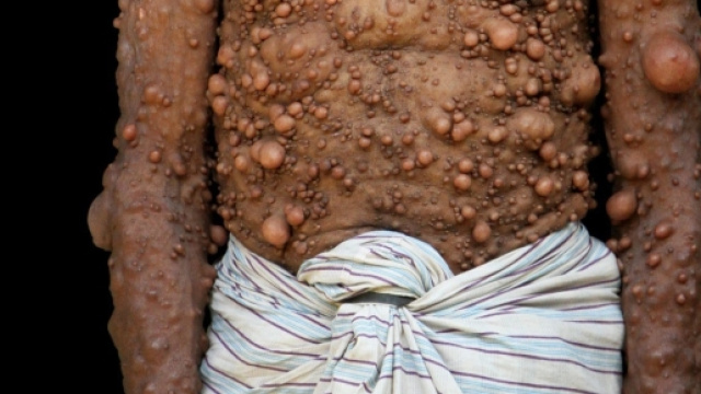 Bangladesh, uomo interamente ricoperto da tumori