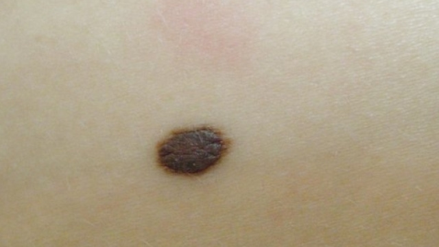 'Clicca il neo', arriva l'app per sconfiggere il melanoma (fonte http://www.centrostudigised.it)