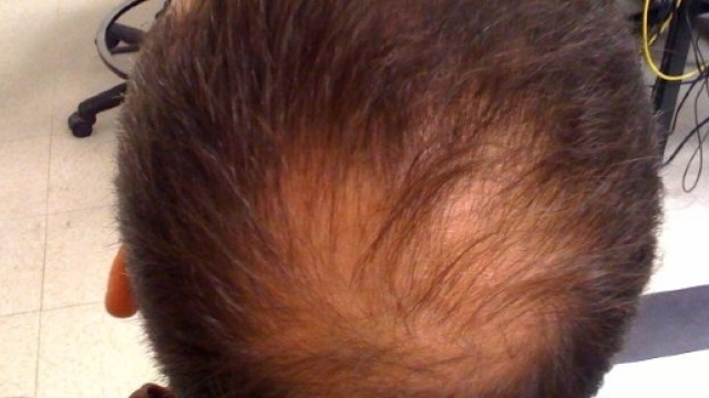 Dalla Scozia nuove speranze per i calvi