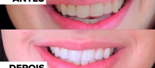 Mais de 1000 ideias sobre Clarear Dentes no Pinterest | Vinagre de ... - pinterest.com