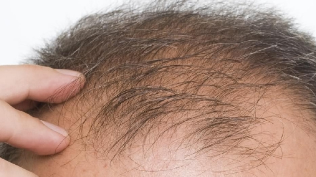 La calvizie? Tutta colpa del cromosoma X