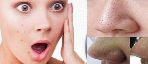 Dicas incr&iacute;veis para ajudar no combate a cravos e espinhas