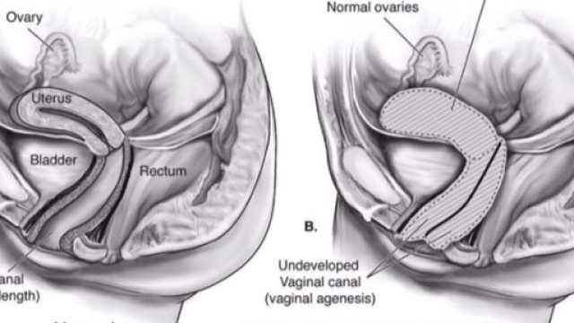 La sindrome di Rokitansky non &egrave; riconosciuta