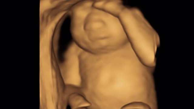 Eva: la bimba americana che nascer&agrave; senza il cervello.