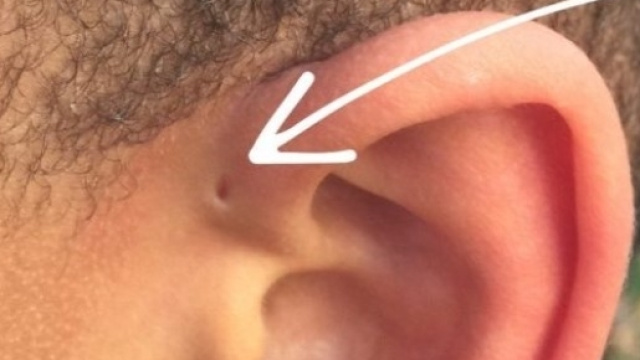 Cos'&egrave; quel forellino vicino all'orecchi? - loZummo News