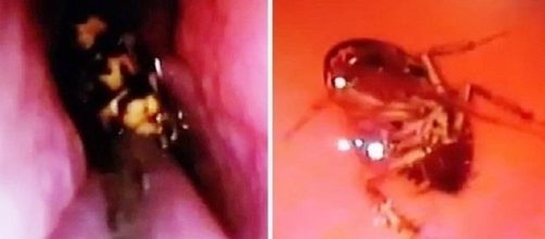 Barata viva dentro de cr&acirc;nio de mulher.