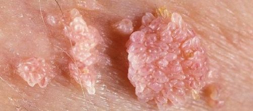 A pessoa pode estar com uma DST e n&atilde;o saber