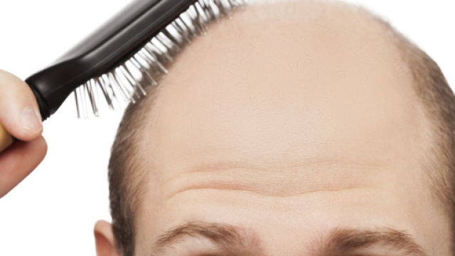 La calvizie precoce colpirebbe specialmente i bassi